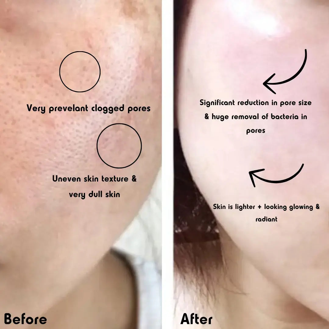 Diamond Derm™