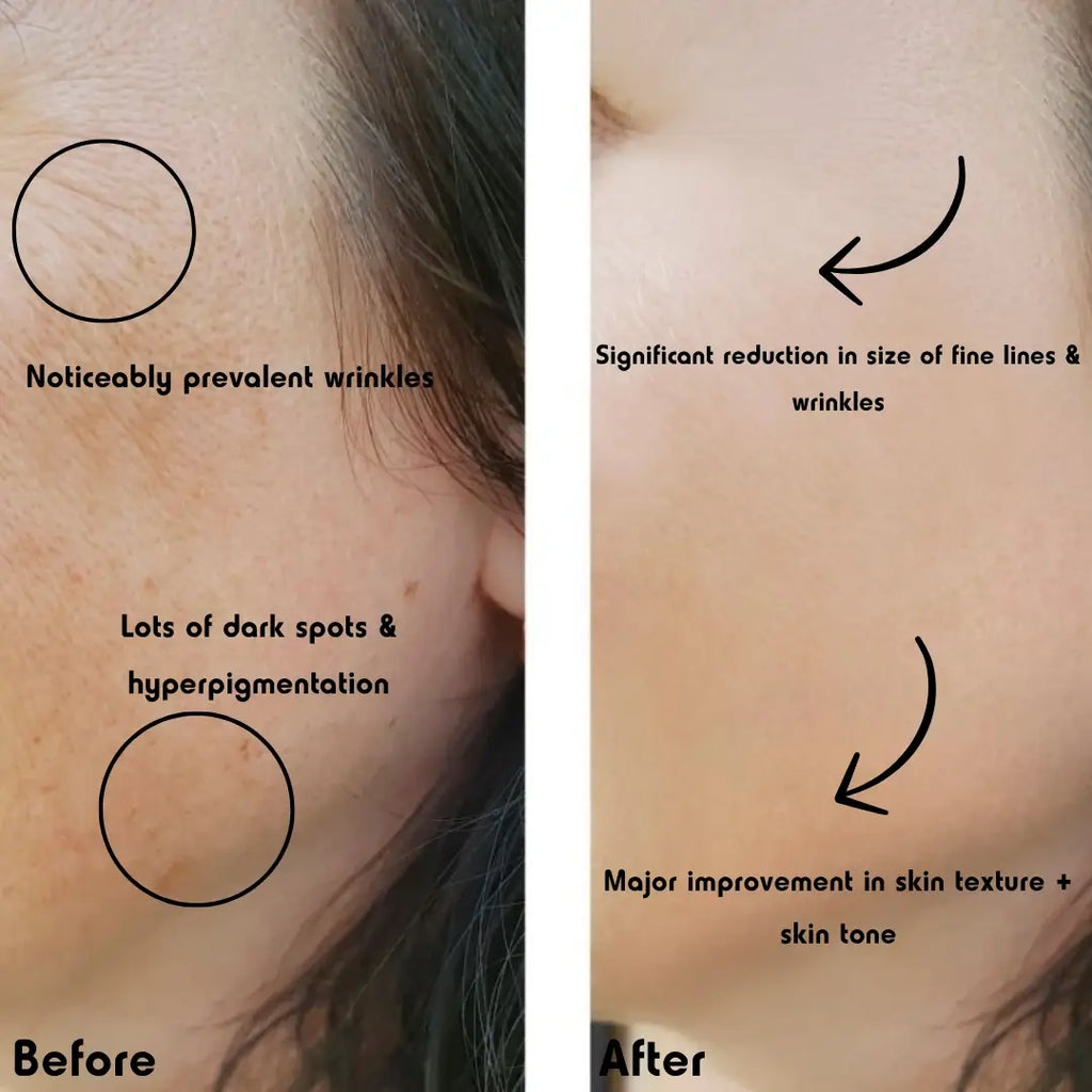 Diamond Derm™